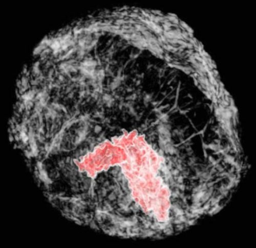 Прорывная техника изображений опухолей груди в 3-D с большой ясностью и уменьшенной радиацией